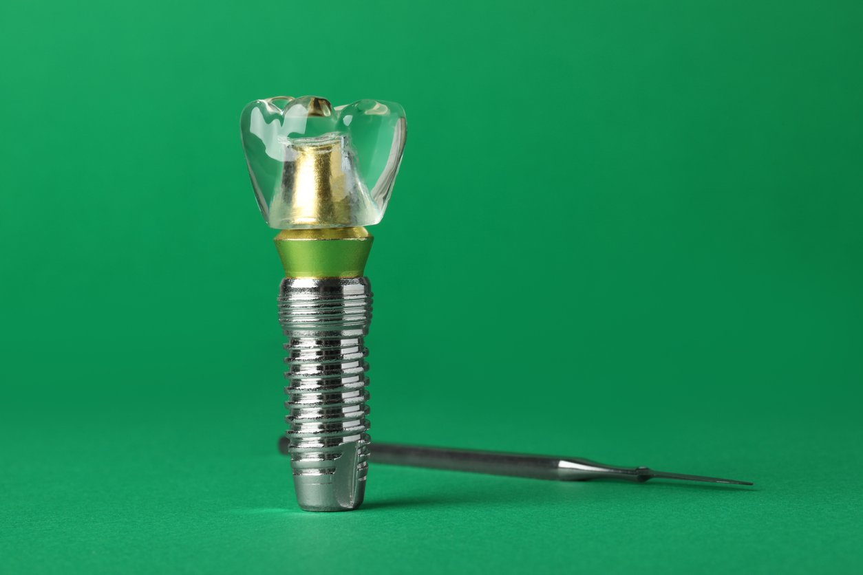 Single-Tooth Dental Implant: dentist example of the titanium rod.